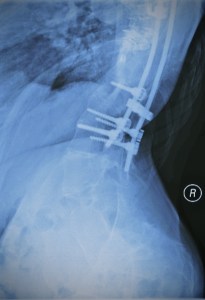 Spinal Fusion