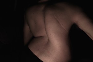 Scars Scoliosis