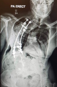 Spinal fusion X-ray